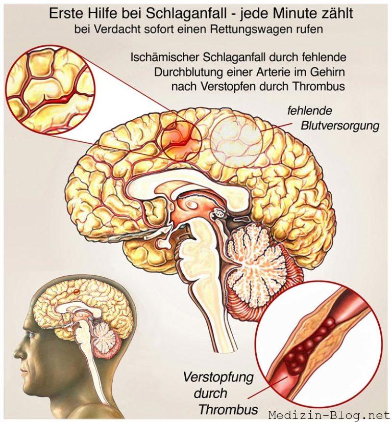 Schlaganfall: Symptome, Ursachen, Behandlung, Vorbeugen ... - Medizin ...