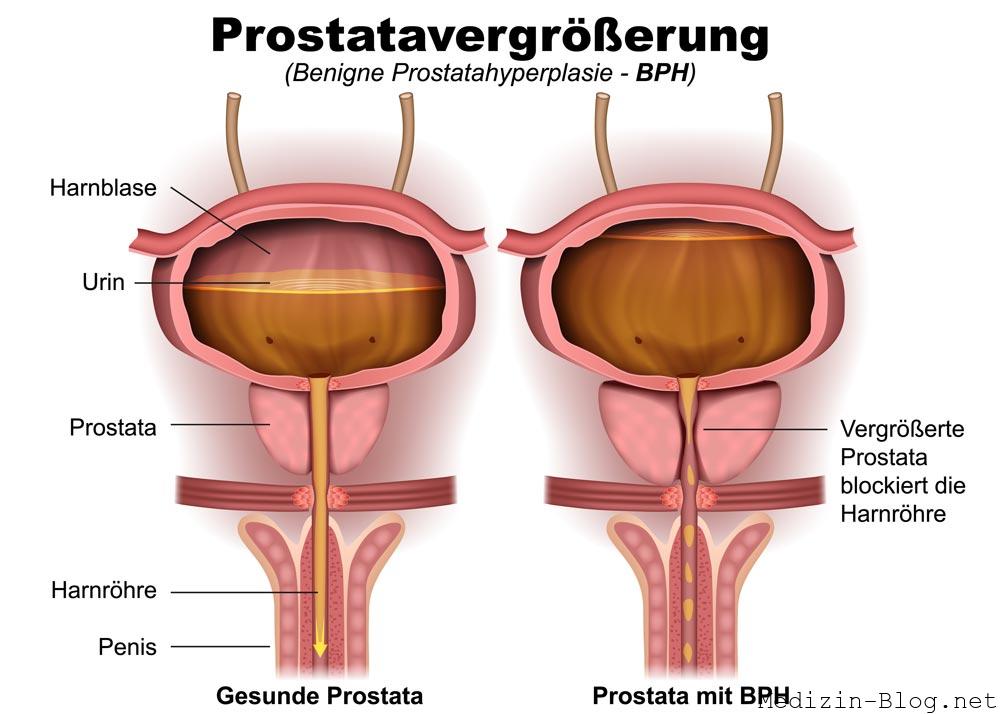 prostatavergroesserung