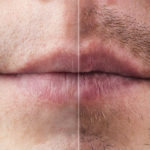 Barttransplantation