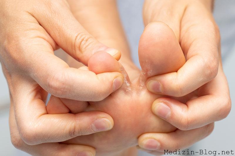 fusspilz