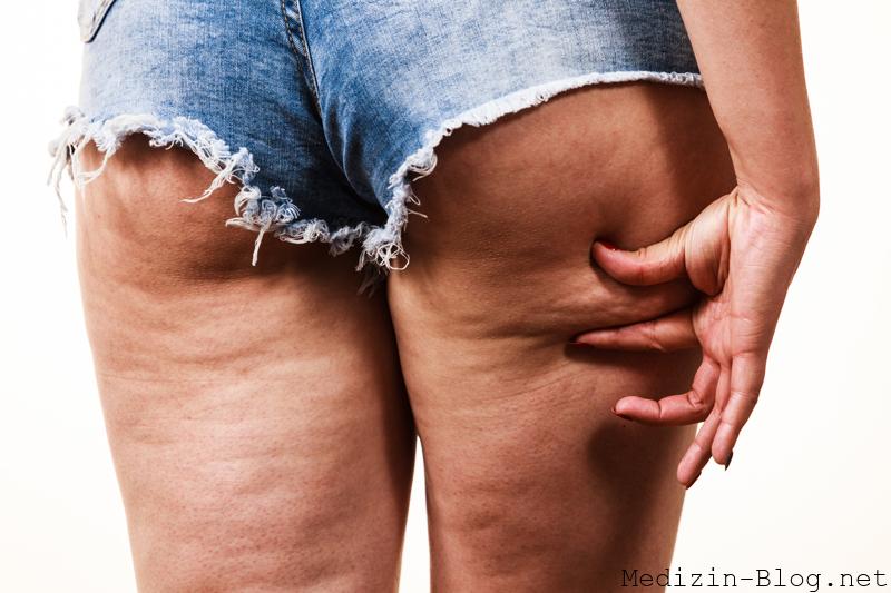 Cellulite