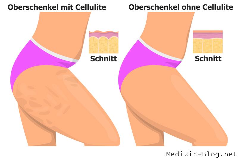 cellulite-vergleich