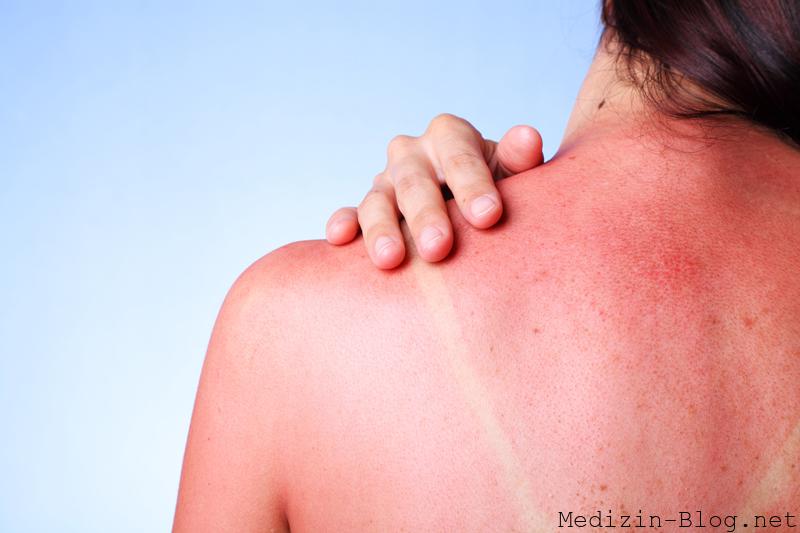 sonnenbrand