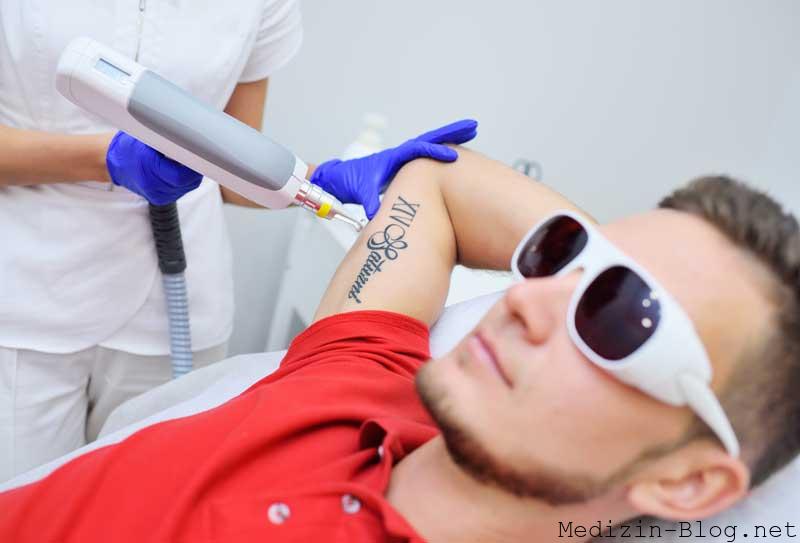 tattooentfernung