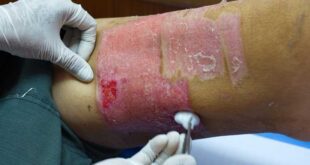 hypertrophes Granulationsgewebe