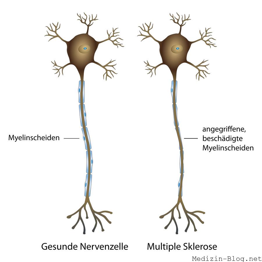 Multiple-Sklerose-nerven