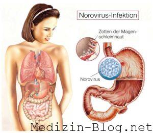 Die aktuelle NorovirusWelle Ein umfassender Überblick