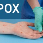 mpox