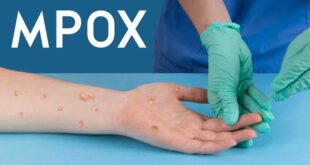 mpox