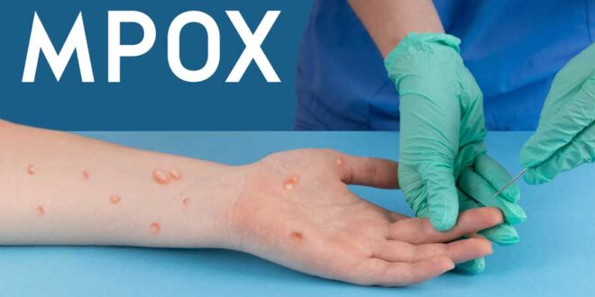 mpox