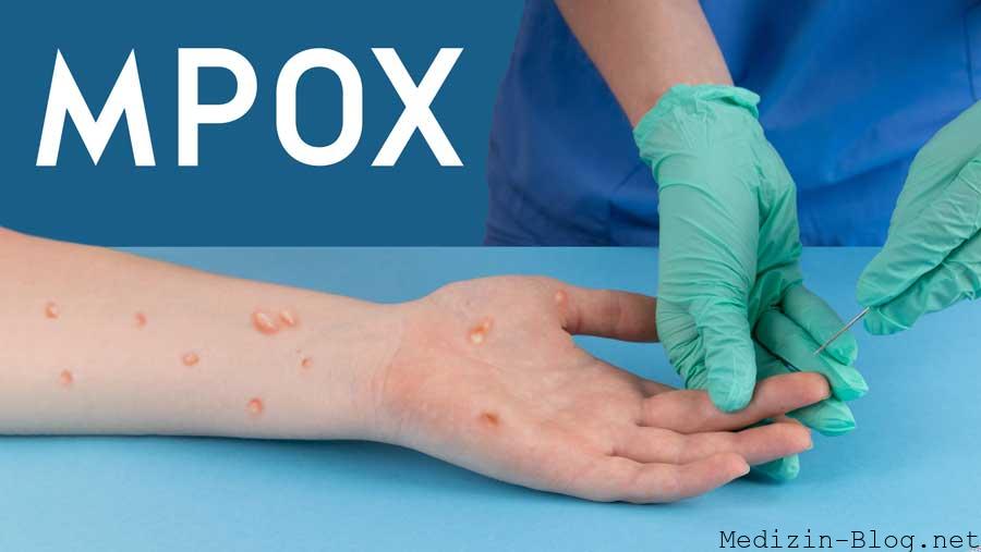 mpox