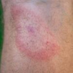 Borreliose