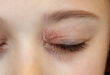 Neurodermitis am Auge