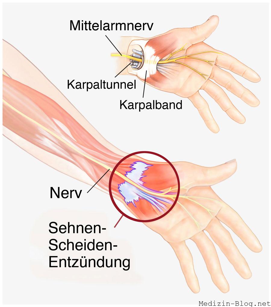 Sehnenscheidenentzündung