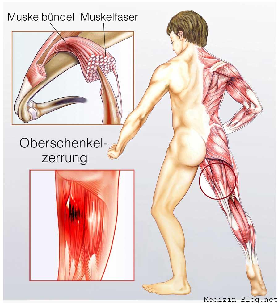 oberschenkelzerrung