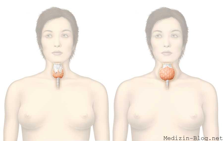 schilddruesen-ueberfunktion