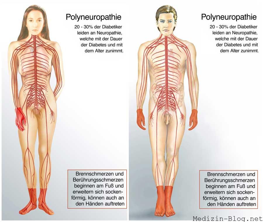 Polyneuropathie