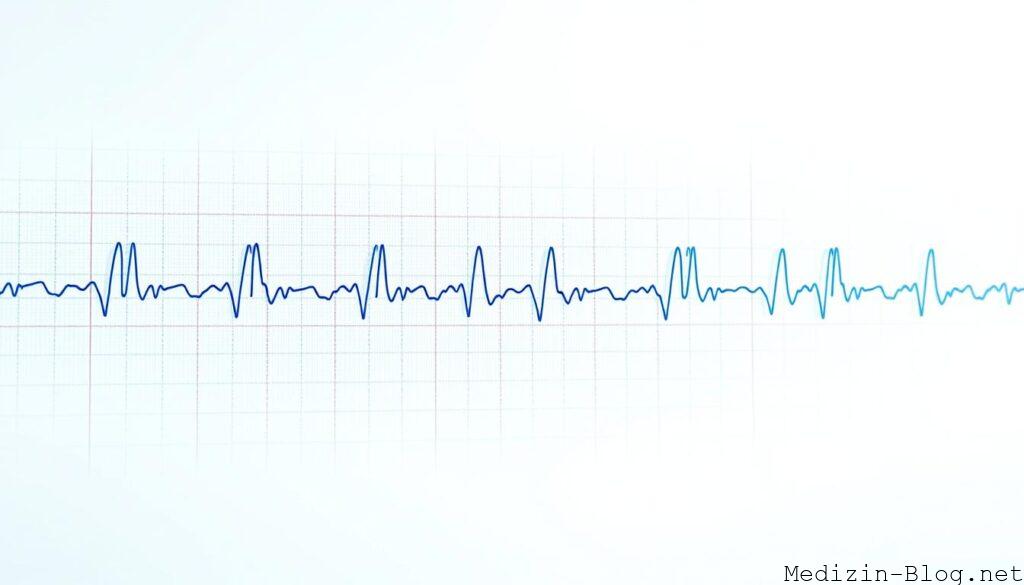 EKG zur Diagnose von Vorhofflimmern