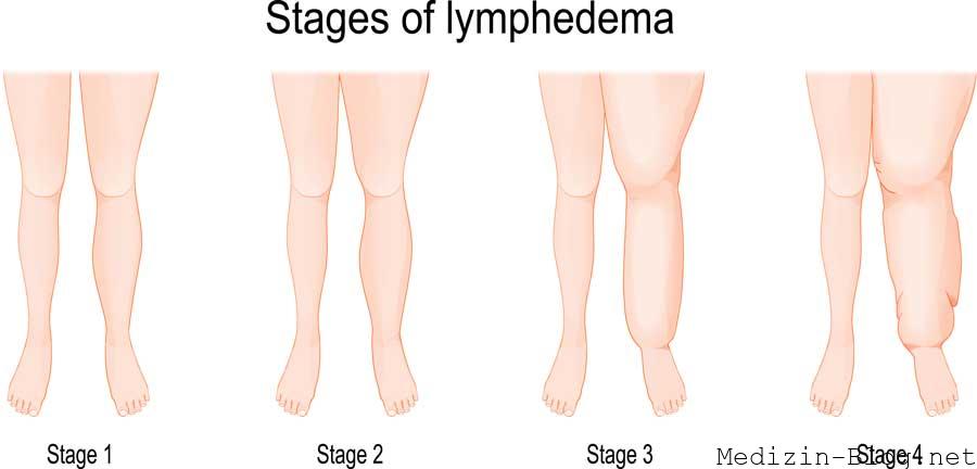 Lipoedem-stage