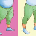 Lipödem vs. Adipositas