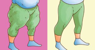 Lipödem vs. Adipositas