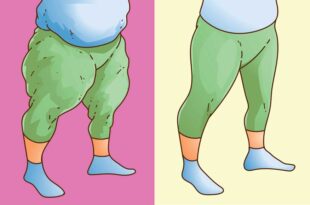 Lipödem vs. Adipositas