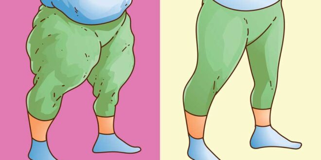 Lipödem vs. Adipositas